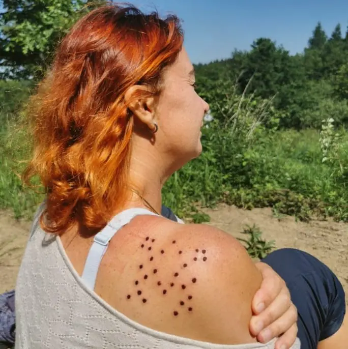 Kambo points on a participant’s shoulder, outdoors in the green